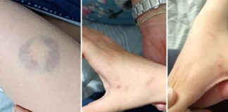 Διευθύντρια σχολείου δάγκωσε 11χρονο μαθητή ΑΜΕΑ στην Άρτα